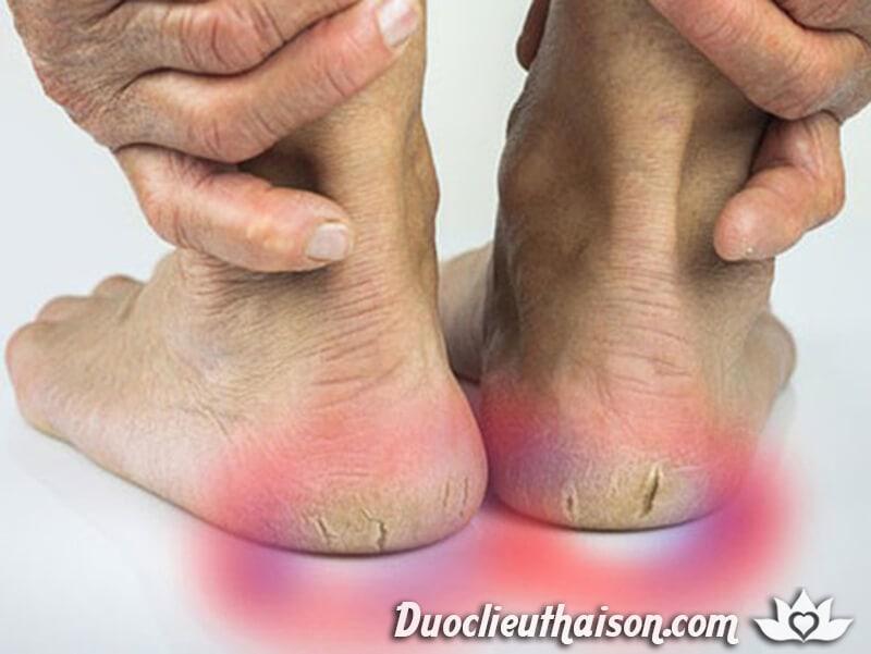 Đau gót chân là bệnh lý phổ biến ở người già và người bị béo phì